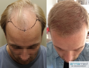 Hair Transplant Armamed Fue Hair Transplantation Technique Fue Hair Transplantation Dr Erkan Demirsoy Hair Transplantation