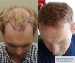 Hair Transplant Armamed Fue Hair Transplantation Technique Fue Hair Transplantation Dr Erkan Demirsoy Hair Transplantation